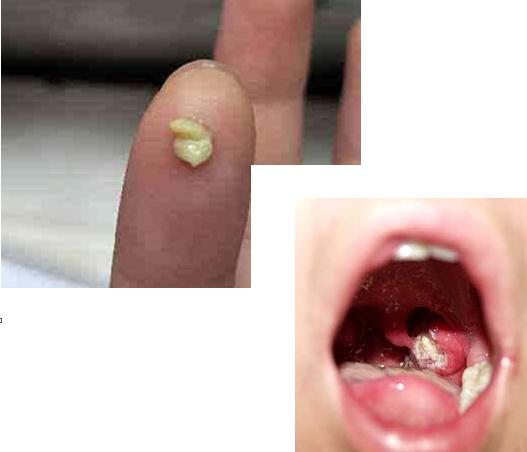 口臭能“熏晕人”？快看看你的扁桃体长了它了没？