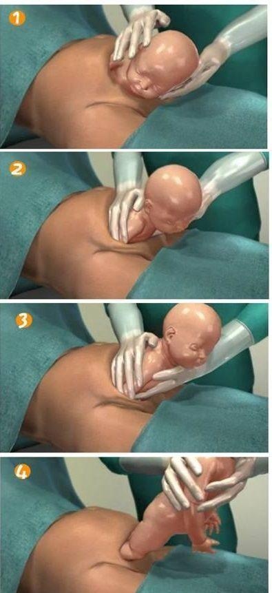 剖腹产全部流程记录,顺产剖腹产的十个真相