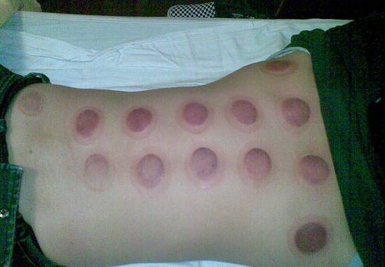 脸上有斑拔罐拔哪个位置图,拔罐的好处和坏处视频