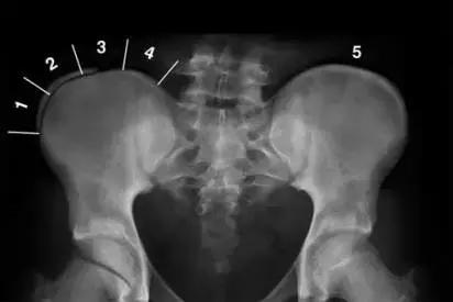 针灸治疗脊柱侧弯的最好方法,脊柱侧弯如何治疗才正确有效