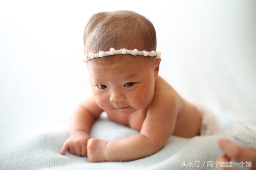 新生儿头皮血肿正确的处理措施,新生儿头皮血肿需要治疗吗