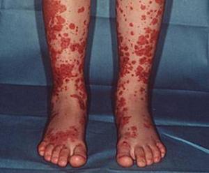 过敏性紫癜发病机制流程图,过敏性紫癜的重要病因病机中医