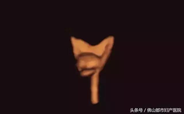 四维超声输卵管造影亲身经历,无痛四维输卵管造影