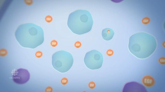 古巴治疗肺癌晚期,古巴肺癌晚期治疗