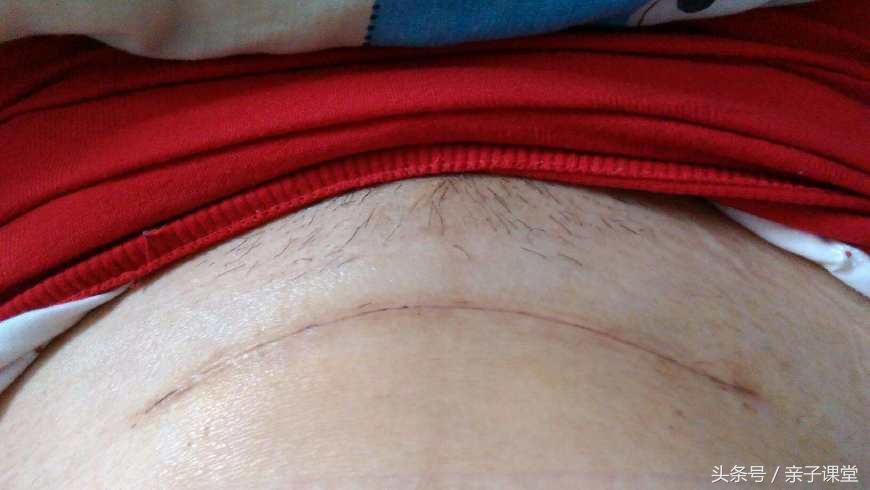 你真正提前了解过剖腹产吗？是什么理由让他们拒绝剖腹产！