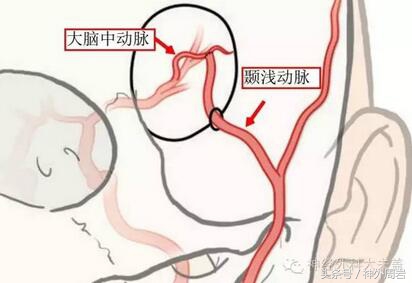 烟雾病脑内出血,烟雾病脑室出血死亡率