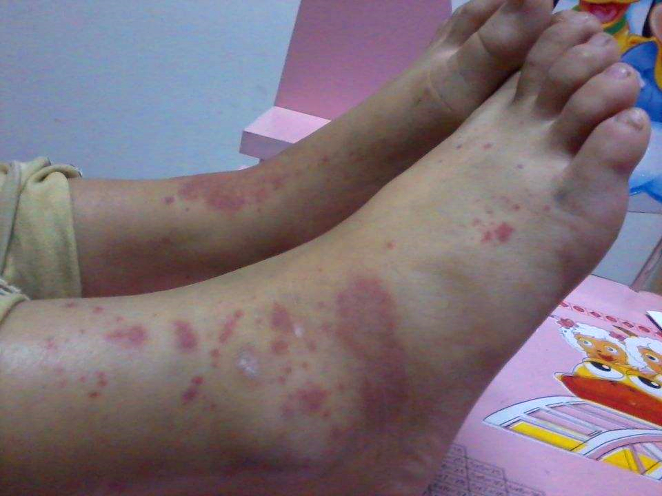 宝宝起了过敏性皮疹,小孩过敏性紫癜是大病还是小病