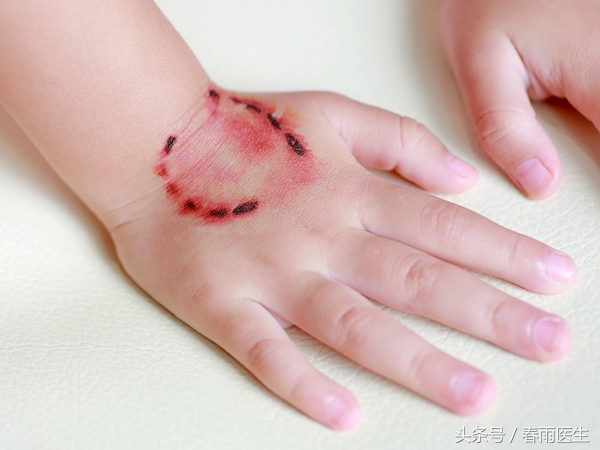 被狗咬了打狂犬疫苗打一针可以吗,被狗咬了打狂犬疫苗