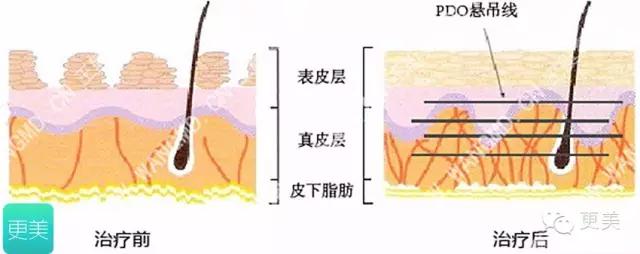 脸部缝美容线好还是普通线好,医院埋线和美容院埋线有什么差别