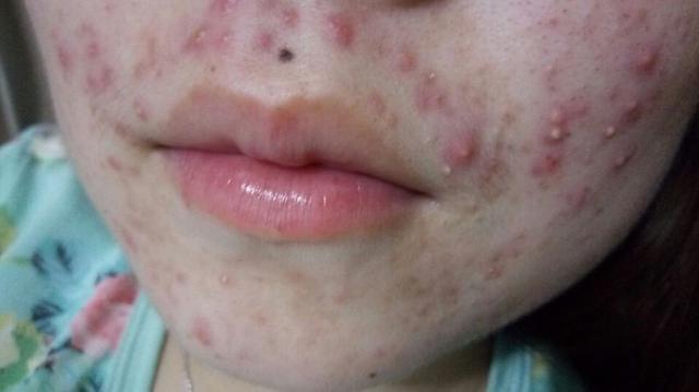 青春痘怎么快速消除不用药物,青春痘怎样消除最简单小方法