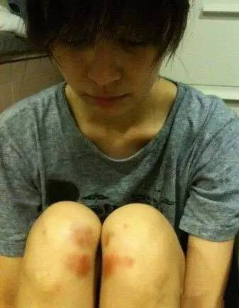 祛疤妙招—日本处方祛疤膏