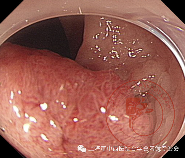 内镜套扎是什么,内镜套扎器械