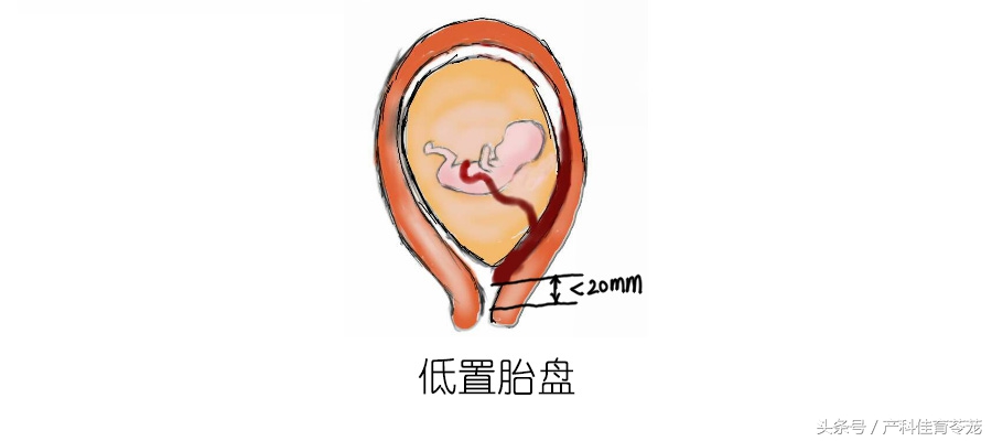 胎盘位置解析,胎盘位置由什么决定