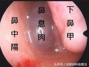 术后如何处理鼻息肉,鼻息肉术后注意事项如何防止复发