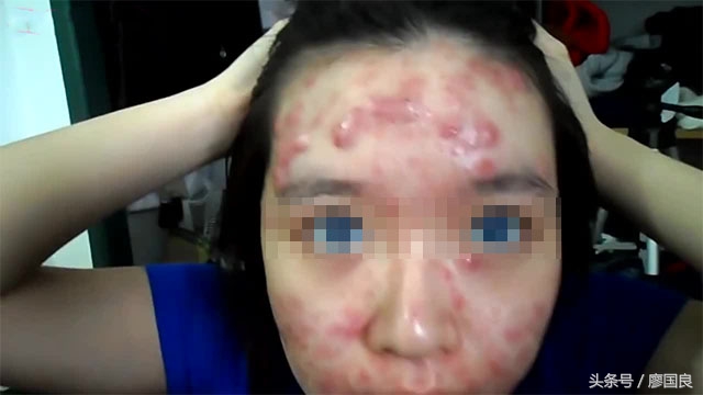 所有祛痘产品都会先爆痘吗,祛痘护肤品安全吗