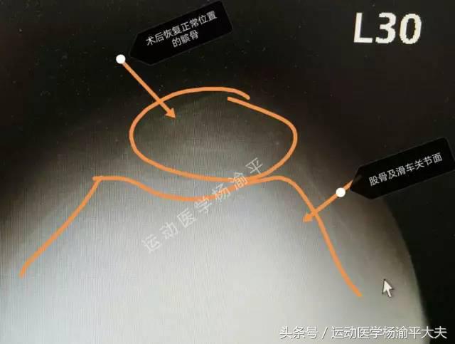 习惯性髌骨脱位微创手术,髌骨习惯性脱位手术刀疤