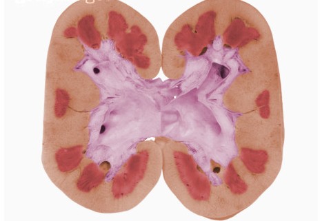 泌尿系统反复感染会导致肾衰竭吗,泌尿系统反复感染怎么治疗彻底