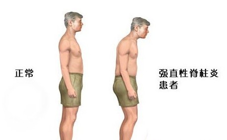 强直性脊柱炎不可告人的秘密,关于强直性脊柱炎的六大误解
