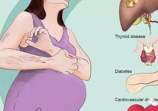 孕妇皮痒拒用药胎盘染成墨绿色肝内胆汁淤积症不可掉以轻心！