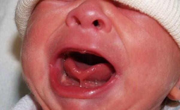 2岁4个月宝宝舌头w型正常吗,1岁宝宝舌头呈w形