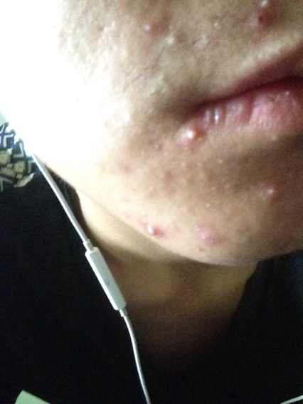 男人嘴周围长痘痘是咋回事,女人嘴周围长痘痘是什么原因