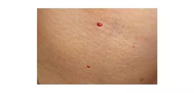 60岁身上现小红痣是什么原因,身上出现小红痣是什么原因造成的