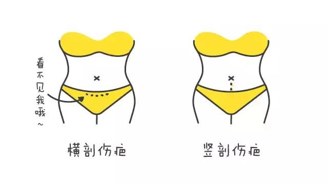 顺产和剖腹产你怎么选,如何选择顺产和剖腹产