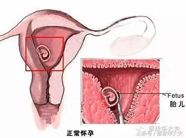 实习医生误诊宫外孕后续,宫角孕和宫外孕会误诊吗