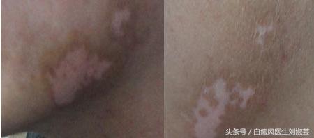 当你得了白癜风,白癜风抹药后起了水泡严重吗