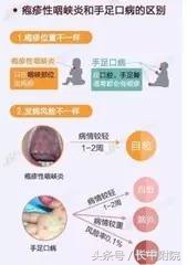 小儿疱疹性咽峡炎用什么中药贴敷,儿科孙丽萍