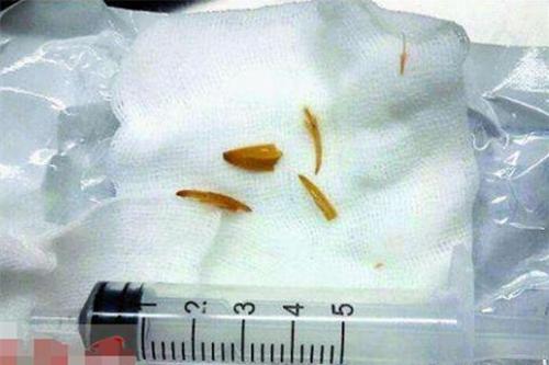 小孩误吞食物卡住喉咙急救,小孩吃东西卡住了海姆立克急救法