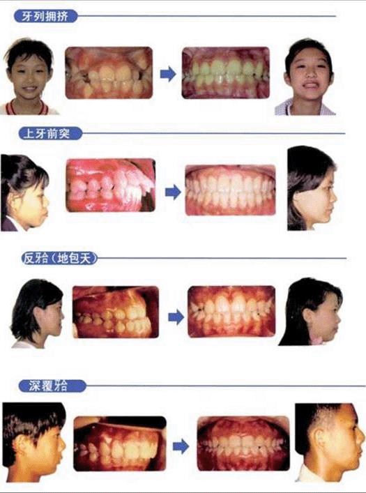 牙齿畸形究竟要不要矫正,儿童牙齿错颌畸形什么时候矫正