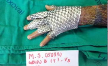 鱼的这个部位千万别吃毒性超强,用鱼皮治烫伤真的可能吗