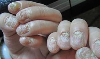 有灰指甲的人的鞋子怎么处理,灰指甲治好了鞋子还能穿吗