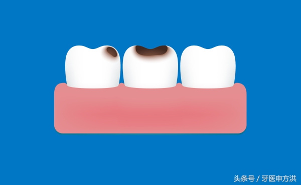 蛀牙从小洞发展到大洞多长时间,牙齿从有蛀牙到完全坏要多长时间