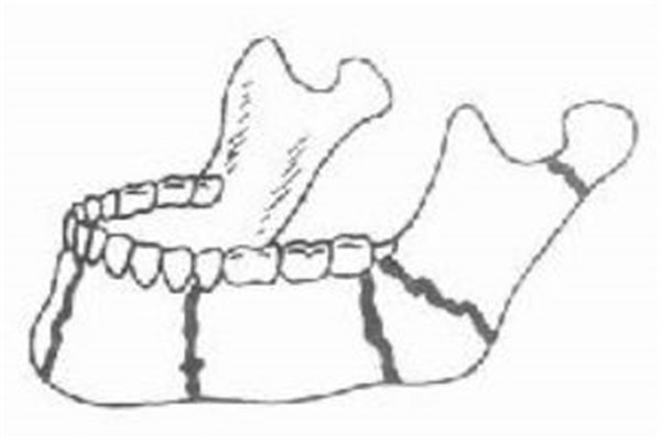 男子牙疼不及时治疗,男子强忍疼痛医院