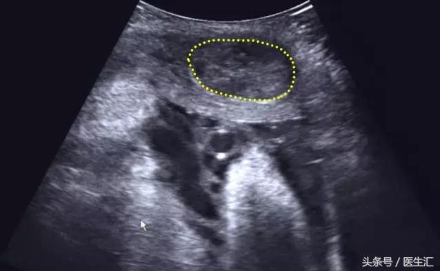 胎盘早剥病例课件,胎盘早剥的超声鉴别诊断