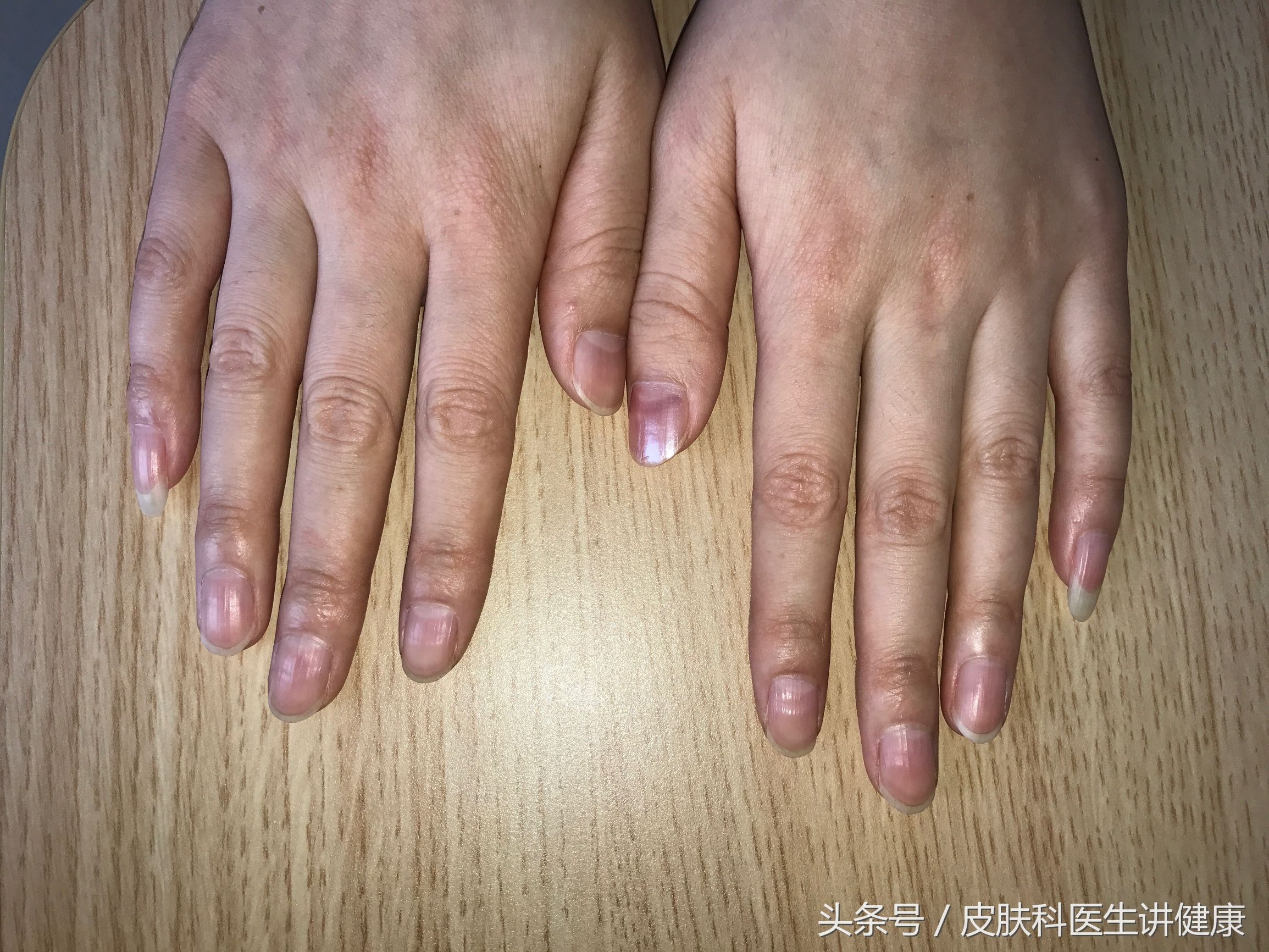 手上很多小水泡是汗疱疹?医生:不是,这是脚气导致的!