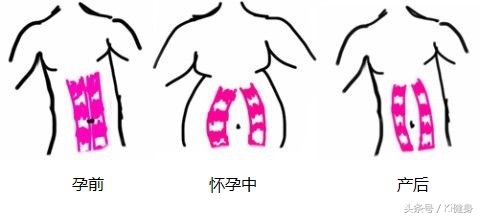 腹直肌上部分离,腹直肌及腹直肌分离