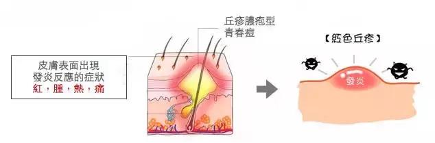 痘痘闭口摸起来还有点疼痛,痘痘闭口反反复复怎么办