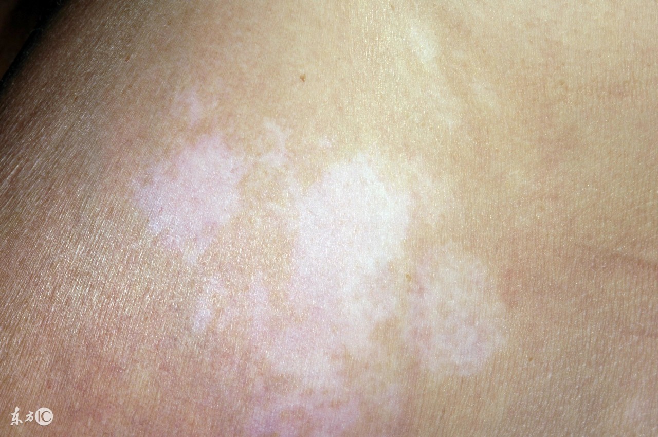 白癜风治疗能有效果吗,屁股上只有一个白癜风可以根治吗