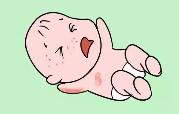 宝宝得湿疹了怎么办小妙招,宝宝湿疹解决全攻略