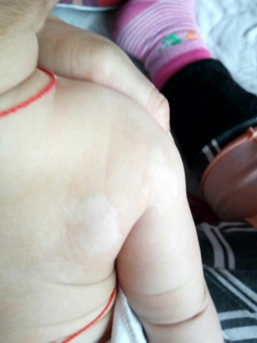 家里两个孩子都长白癜风怎么回事,孩子身上有两块白斑该怎么查