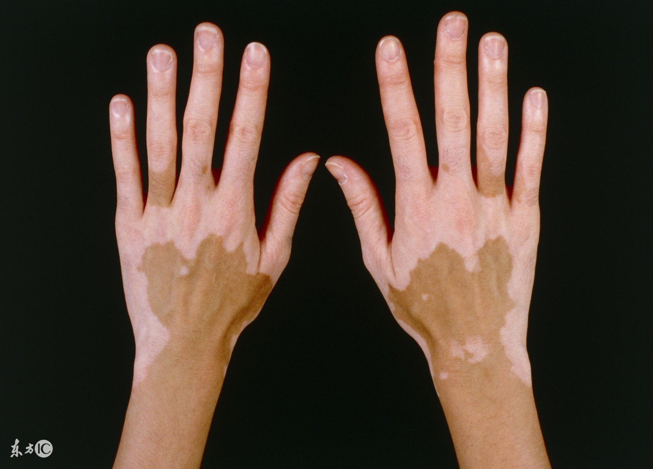 白癜风治疗能有效果吗,屁股上只有一个白癜风可以根治吗