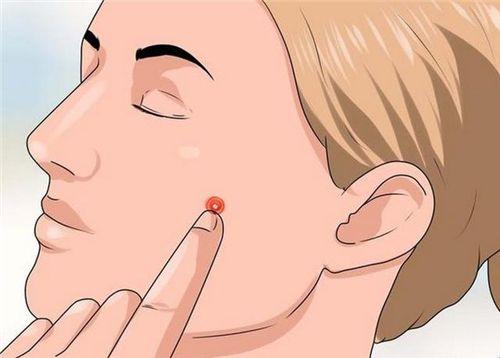 青春痘和普通痘痘有什么区别,什么样的痘痘才是青春痘