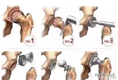 髋关节置换后护理康复训练视频,髋关节置换术后康复护理app