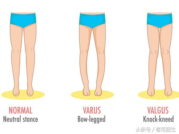 走路罗圈腿怎么治疗,罗圈腿x型腿现在好治吗