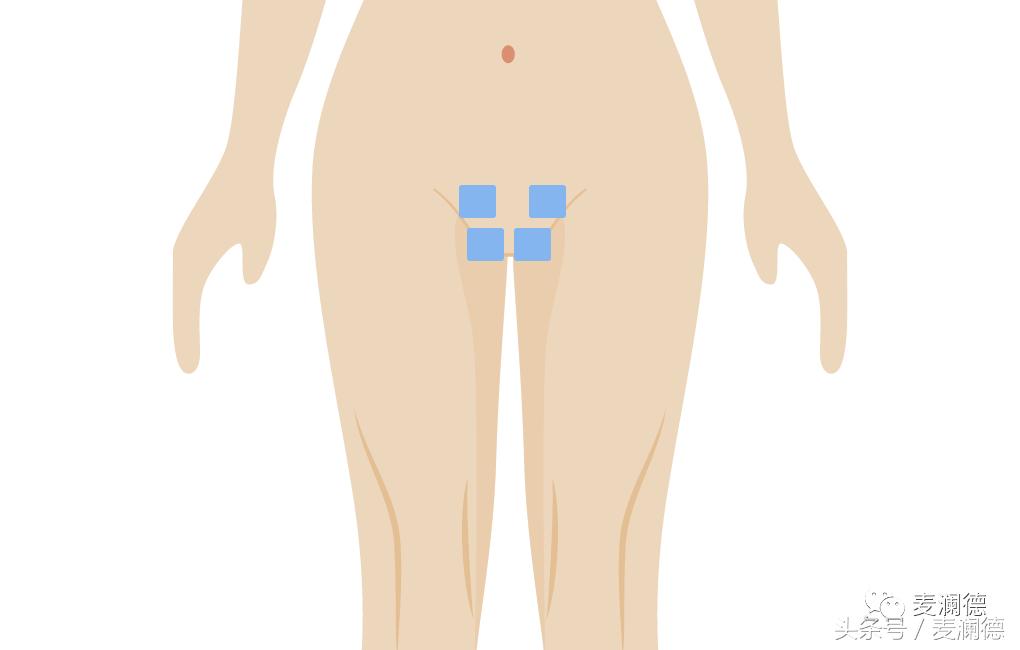 产后腰臀肥大,如何改善产后耻骨联合前凸