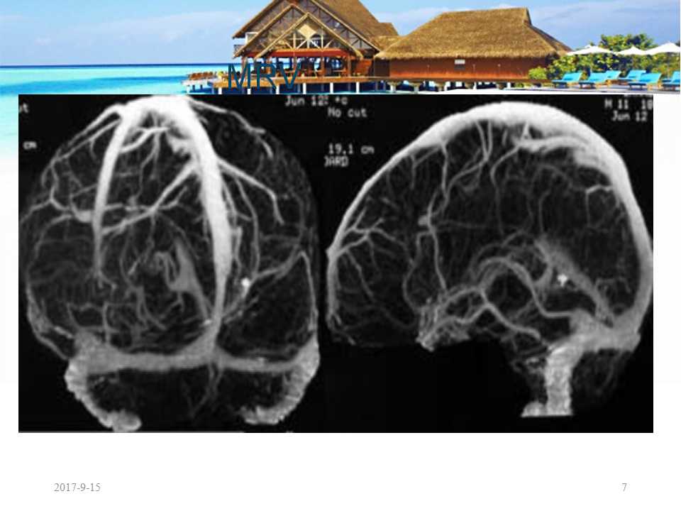 颅内静脉窦血栓形成怎么治疗,颅内静脉窦血栓怎么治疗