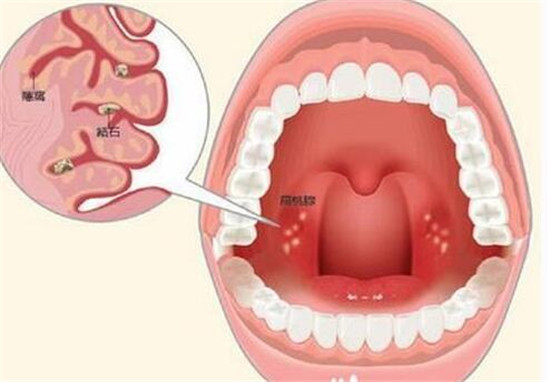 怎么可以彻底治愈扁桃体结石,扁桃体结石能否彻底治愈